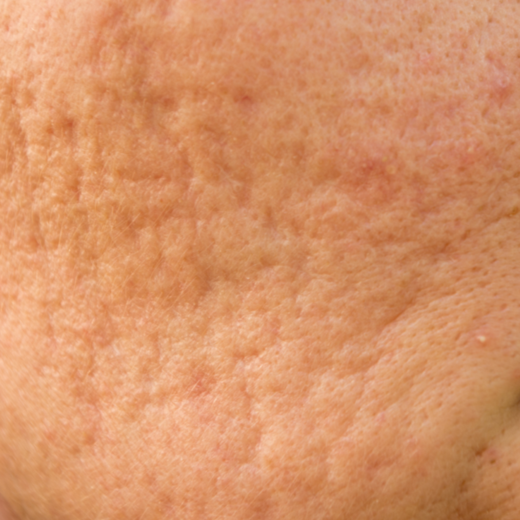 Littekens behandeling Zhenzhu Skin Clinic